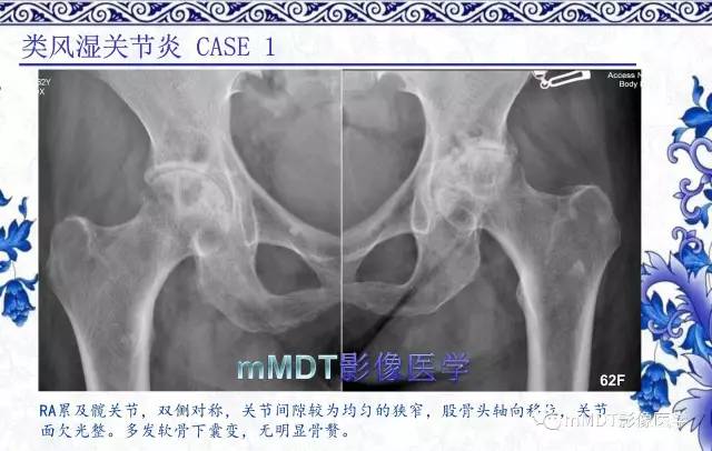 【PPT】髋关节部分常见病变的鉴别诊断