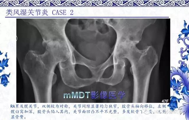 【PPT】髋关节部分常见病变的鉴别诊断
