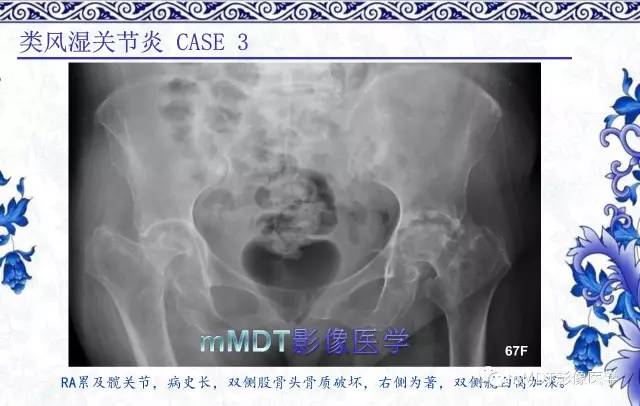 【PPT】髋关节部分常见病变的鉴别诊断