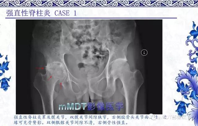 【PPT】髋关节部分常见病变的鉴别诊断