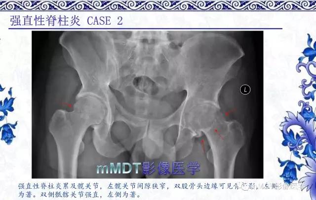 【PPT】髋关节部分常见病变的鉴别诊断