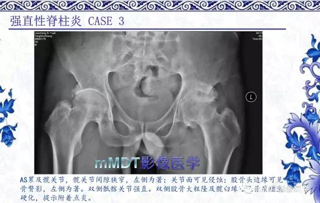 【PPT】髋关节部分常见病变的鉴别诊断