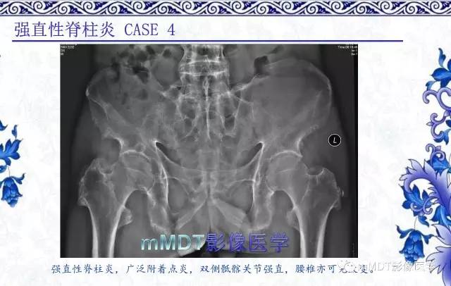 【PPT】髋关节部分常见病变的鉴别诊断