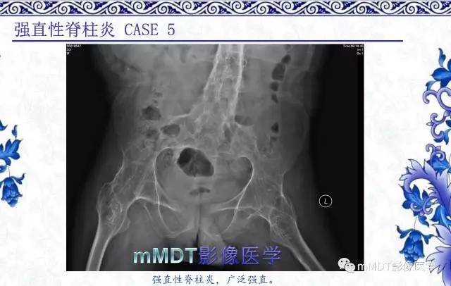 【PPT】髋关节部分常见病变的鉴别诊断