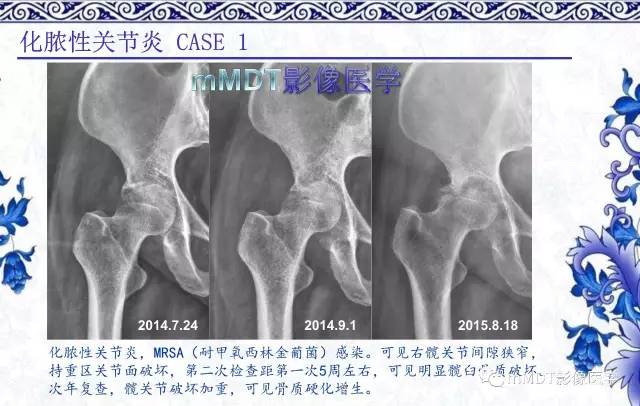 【PPT】髋关节部分常见病变的鉴别诊断