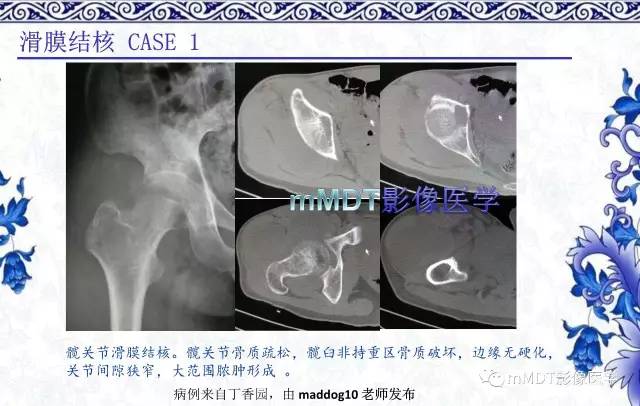 【PPT】髋关节部分常见病变的鉴别诊断