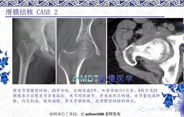【PPT】髋关节部分常见病变的鉴别诊断
