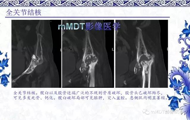 【PPT】髋关节部分常见病变的鉴别诊断