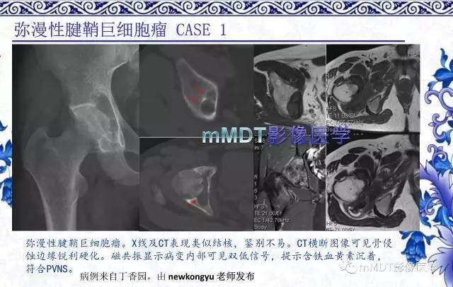 【PPT】髋关节部分常见病变的鉴别诊断