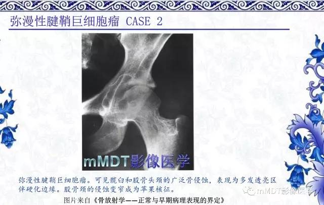 【PPT】髋关节部分常见病变的鉴别诊断