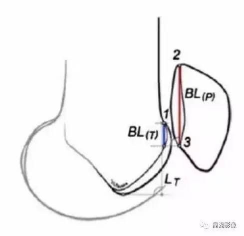 高位髌骨常用测量方法 高位髌骨常用测量方法