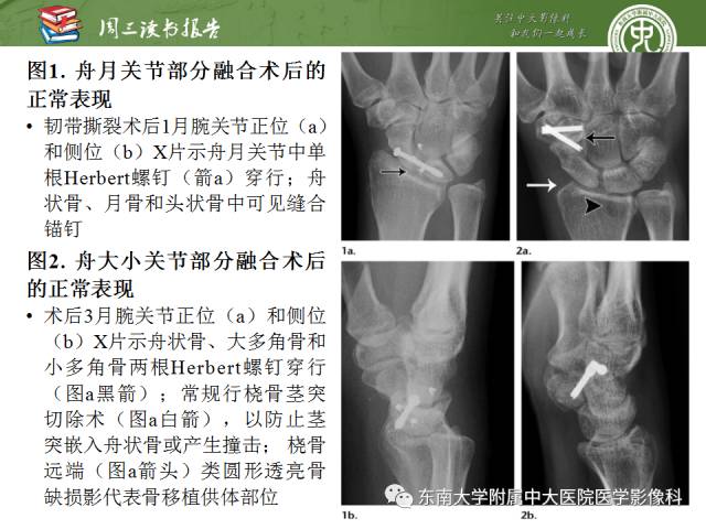 【PPT】腕关节炎术后影像评估