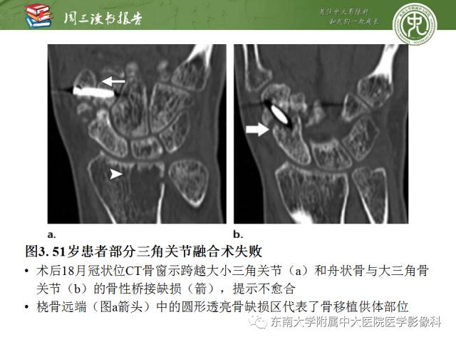 【PPT】腕关节炎术后影像评估