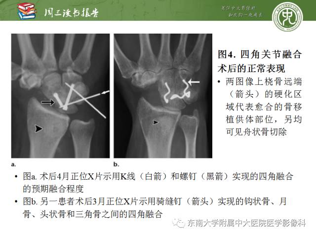 【PPT】腕关节炎术后影像评估