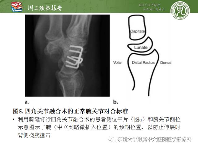 【PPT】腕关节炎术后影像评估