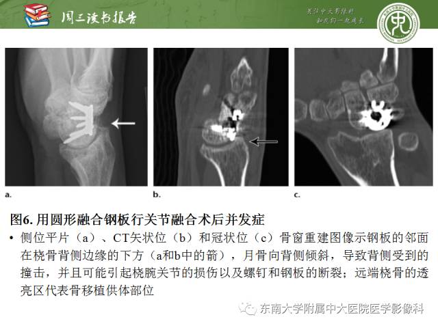 【PPT】腕关节炎术后影像评估