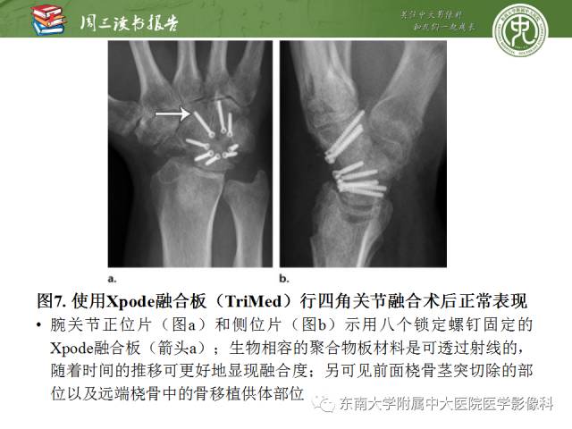 【PPT】腕关节炎术后影像评估