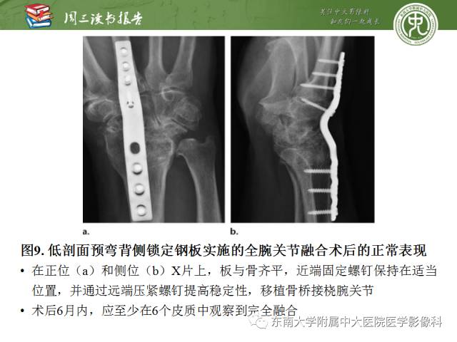 【PPT】腕关节炎术后影像评估