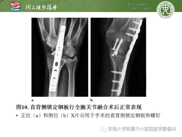 【PPT】腕关节炎术后影像评估