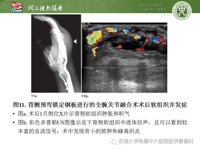 【PPT】腕关节炎术后影像评估