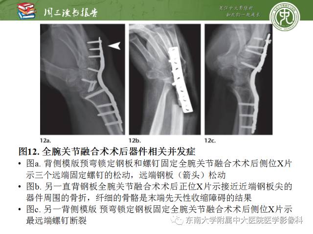 【PPT】腕关节炎术后影像评估