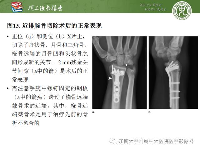 【PPT】腕关节炎术后影像评估
