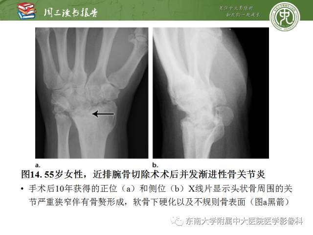 【PPT】腕关节炎术后影像评估