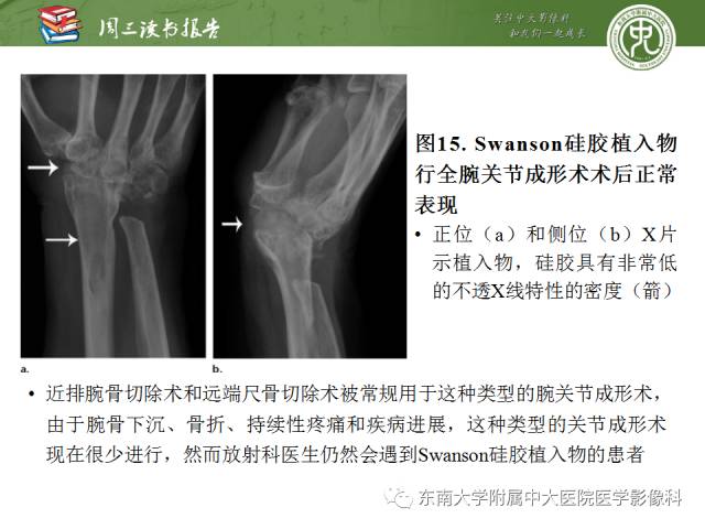【PPT】腕关节炎术后影像评估