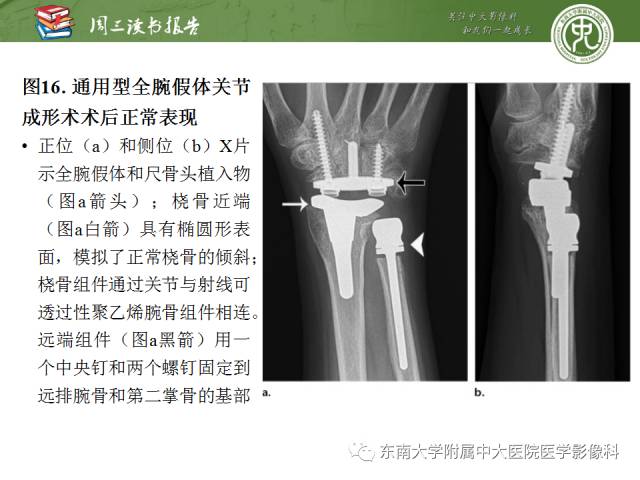 【PPT】腕关节炎术后影像评估