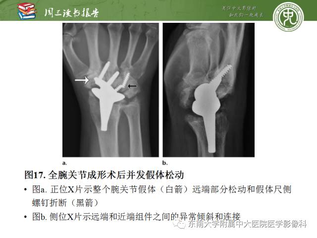 【PPT】腕关节炎术后影像评估