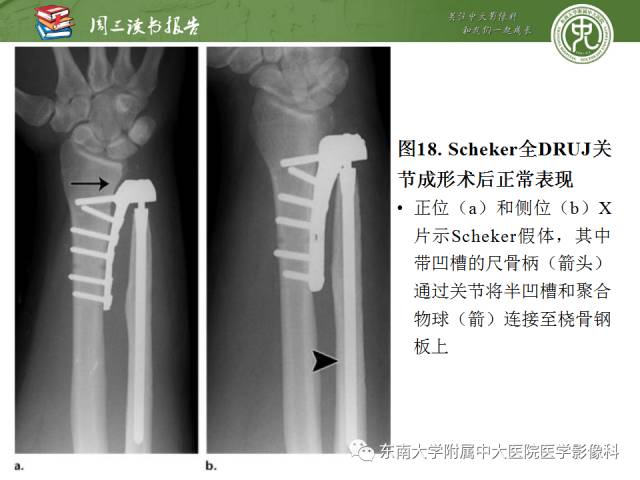 【PPT】腕关节炎术后影像评估