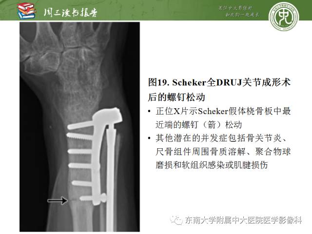 【PPT】腕关节炎术后影像评估