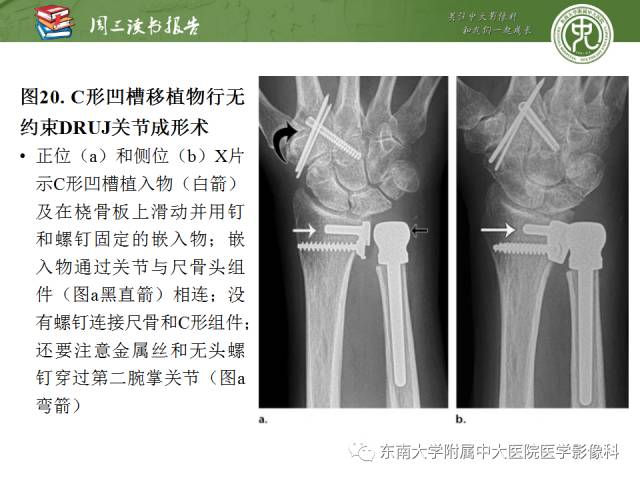 【PPT】腕关节炎术后影像评估