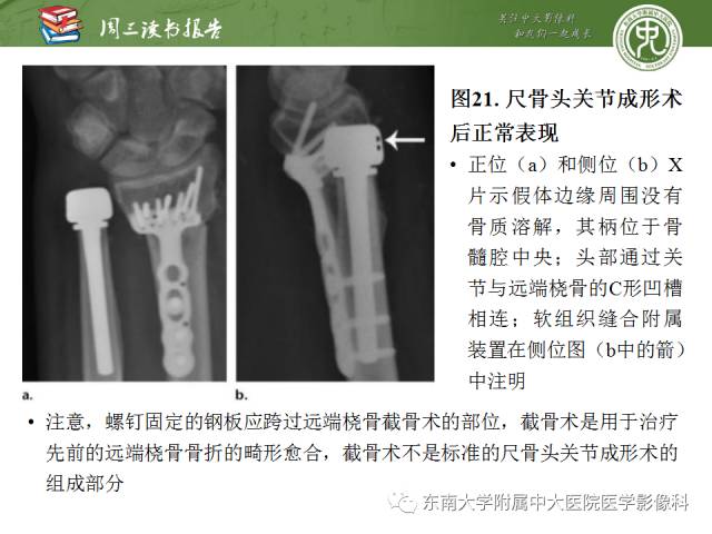 【PPT】腕关节炎术后影像评估