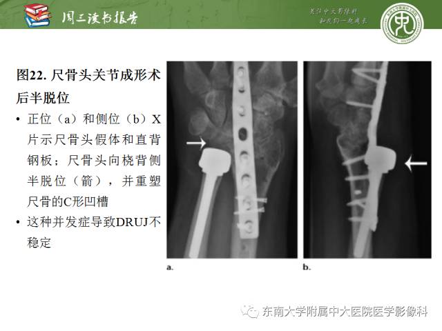 【PPT】腕关节炎术后影像评估