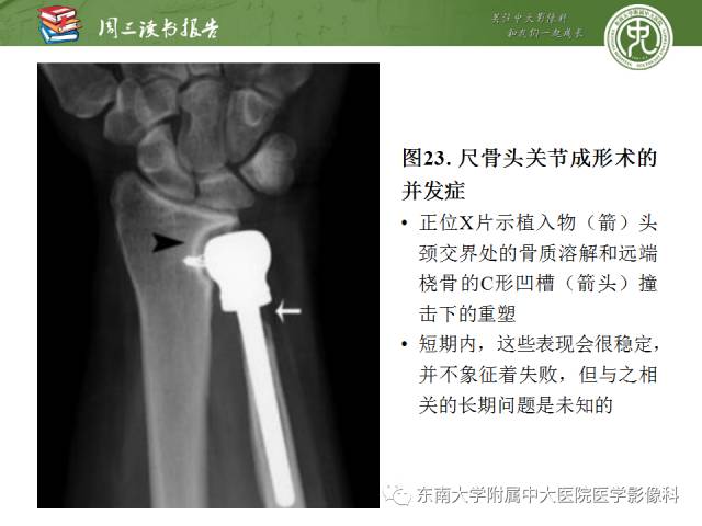 【PPT】腕关节炎术后影像评估