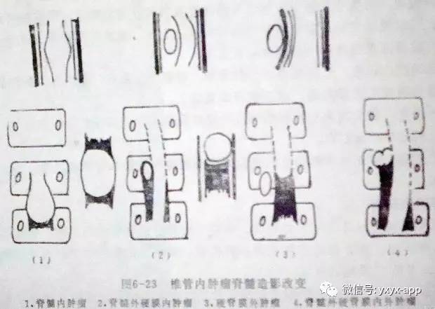 【病例】脊膜瘤1例MR