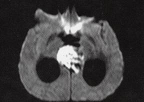 【病例】松果体区皮样囊肿1例MR 【病例】松果体区皮样囊肿1例MR