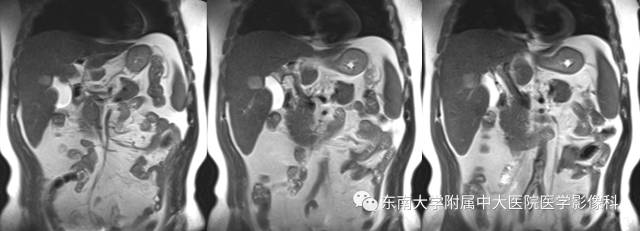 【病例】原发性肝癌1例CT及MR影像表现