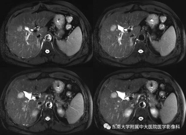 【病例】原发性肝癌1例CT及MR影像表现