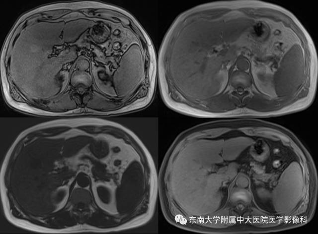 【病例】原发性肝癌1例CT及MR影像表现