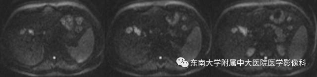 【病例】原发性肝癌1例CT及MR影像表现