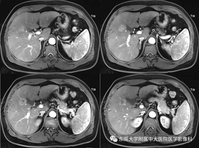 【病例】原发性肝癌1例CT及MR影像表现