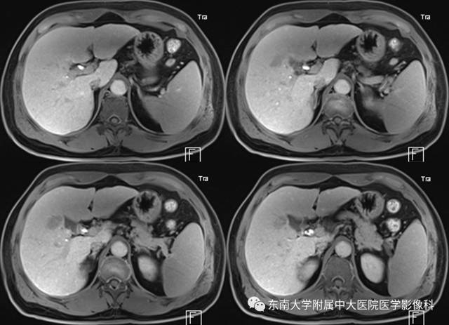 【病例】原发性肝癌1例CT及MR影像表现