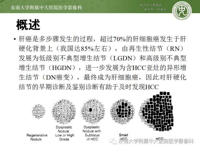 【病例】原发性肝癌1例CT及MR影像表现