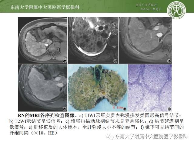 【病例】原发性肝癌1例CT及MR影像表现