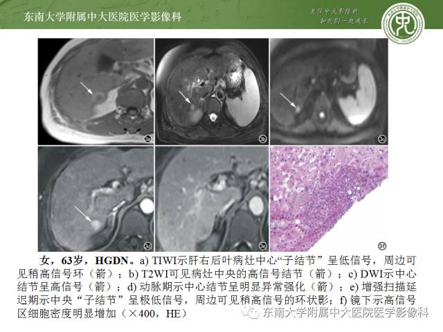 【病例】原发性肝癌1例CT及MR影像表现