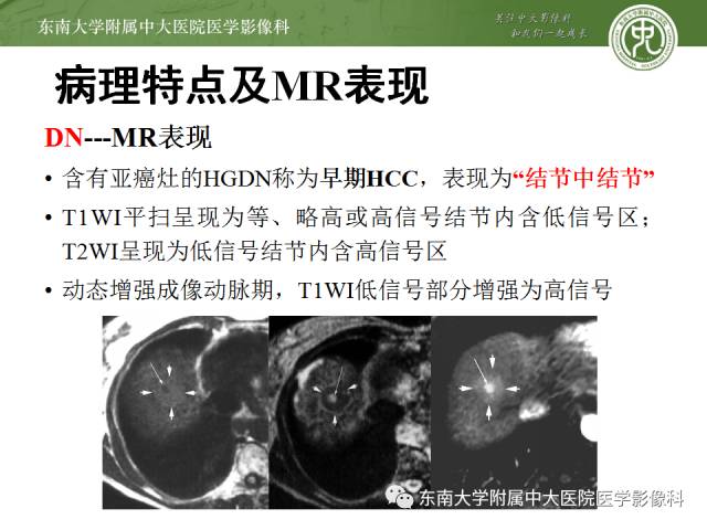 【病例】原发性肝癌1例CT及MR影像表现