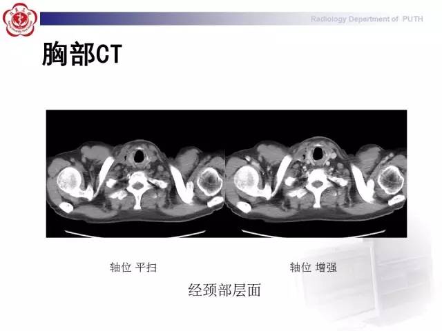 【病例】智齿诱发下行性坏死性纵隔炎1例CT