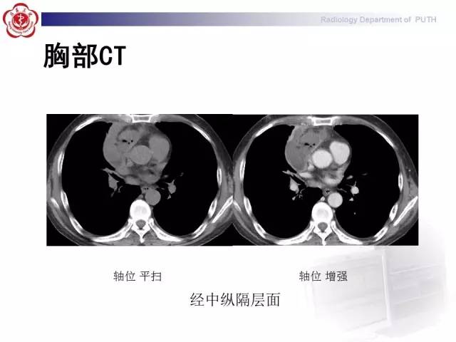 【病例】智齿诱发下行性坏死性纵隔炎1例CT